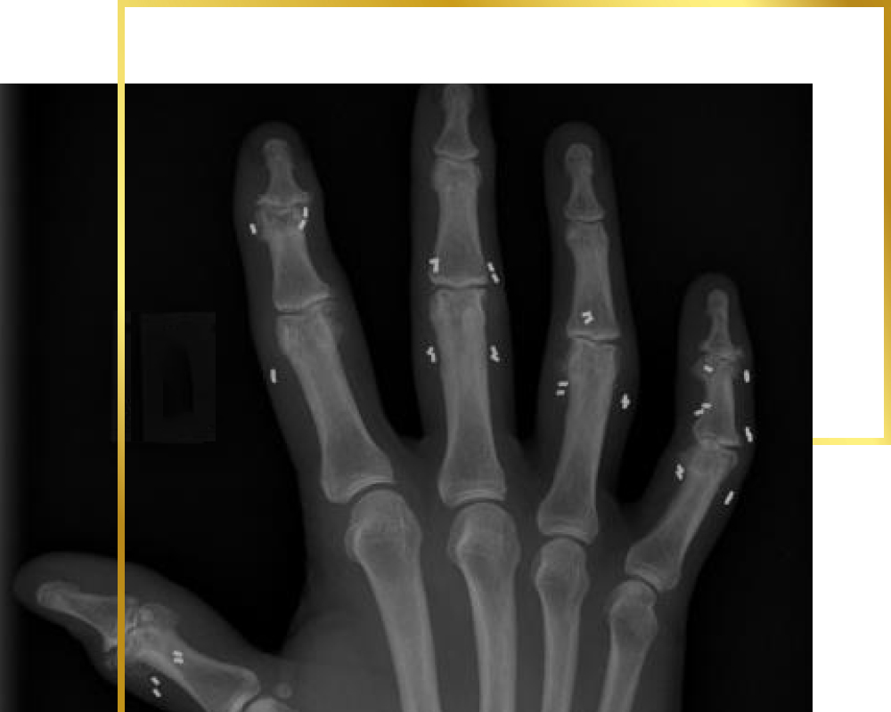 Goldimplantate in Fingergelenken, Goldtherapie, Schmerztherapie