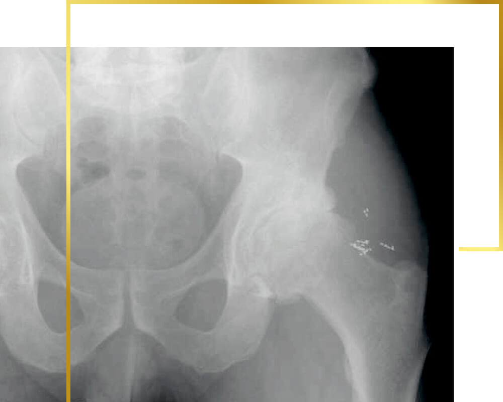 Goldimplantate in Hüftgelenken, Goldtherapie, Schmerztherapie