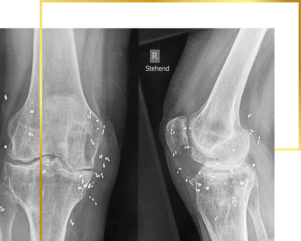 Goldimplantate in Kniegelenken, Goldtherapie, Schmerztherapie