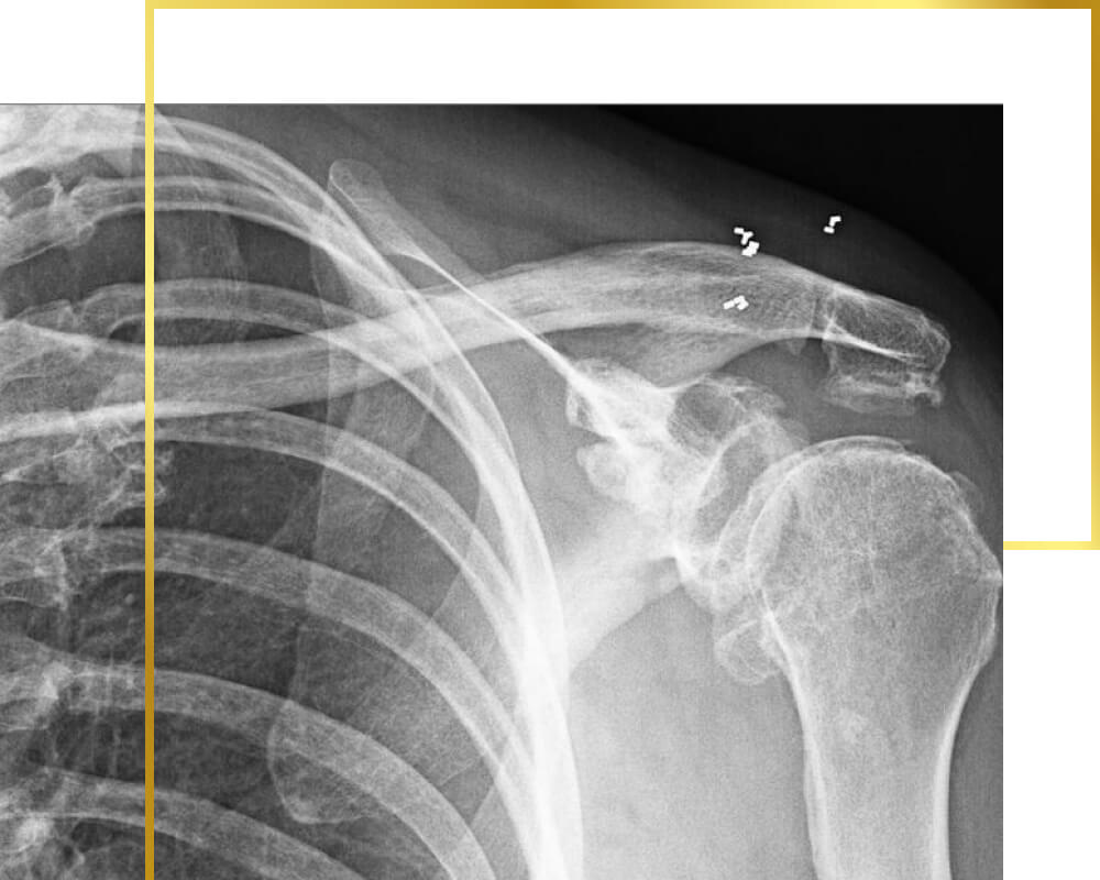 Goldimplantate in Schultergelenken, Goldtherapie, Schmerztherapie