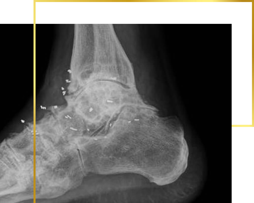Goldimplantate in Sprungelenken, Goldtherapie, Schmerztherapie