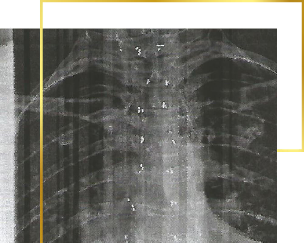 Goldimplantate im Rücken, Wirbelsäule, Brust, Lenden, Goldtherapie, Schmerztherapie