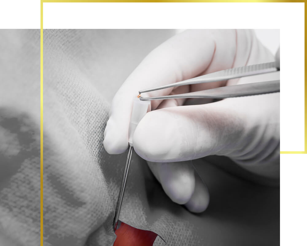 Costs of gold implantation, gold therapy
